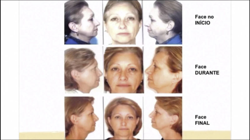 Harmonização Facial Isabel Piatti