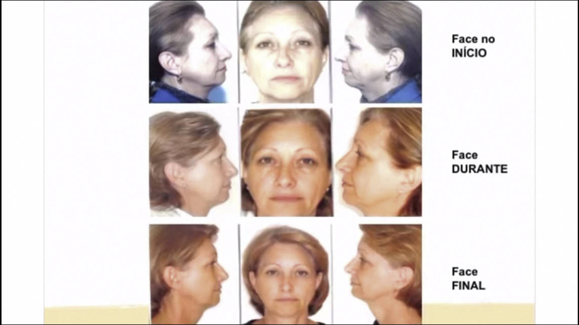 Harmonização Facial Isabel Piatti